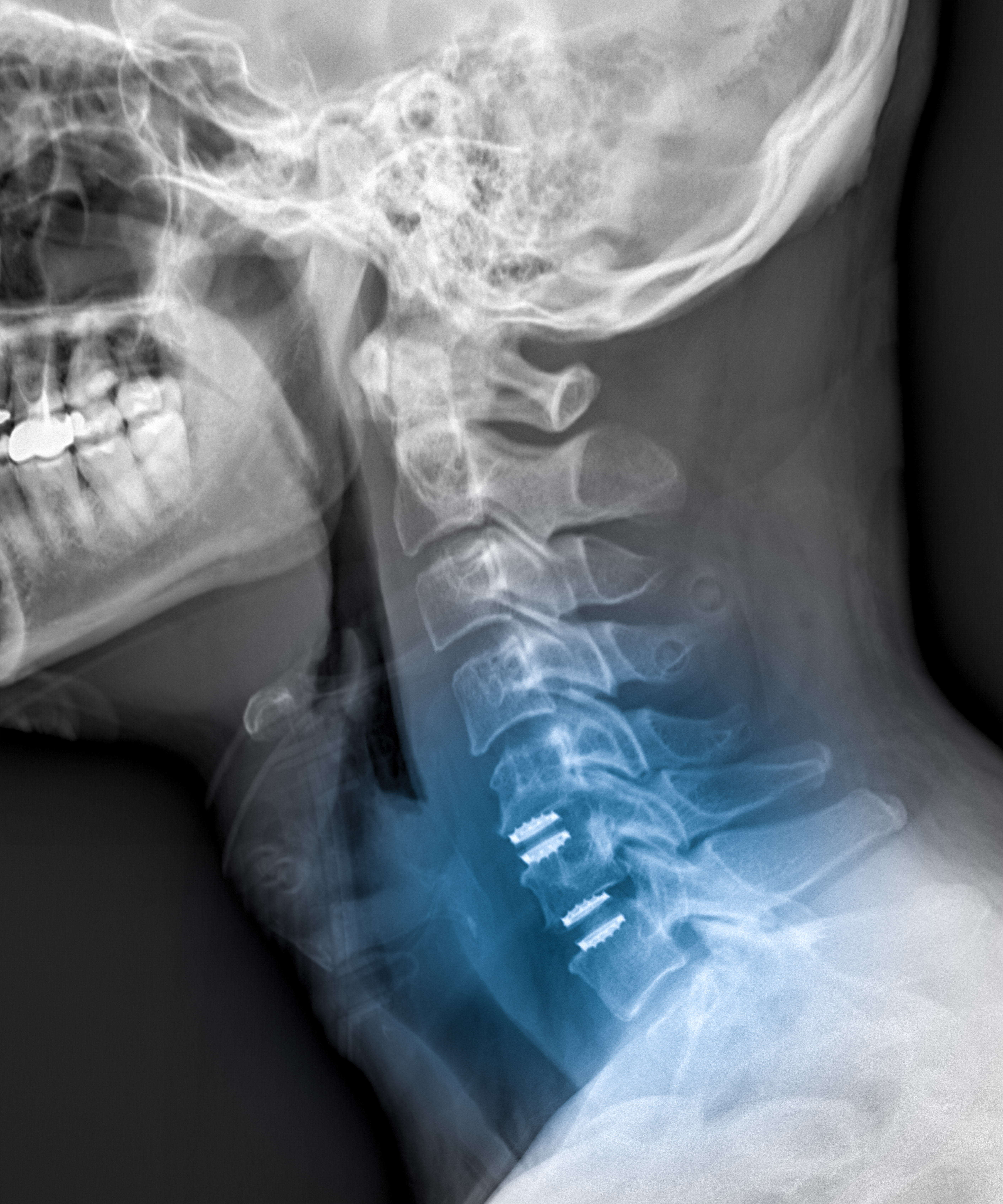 Minimally invasive discectomy