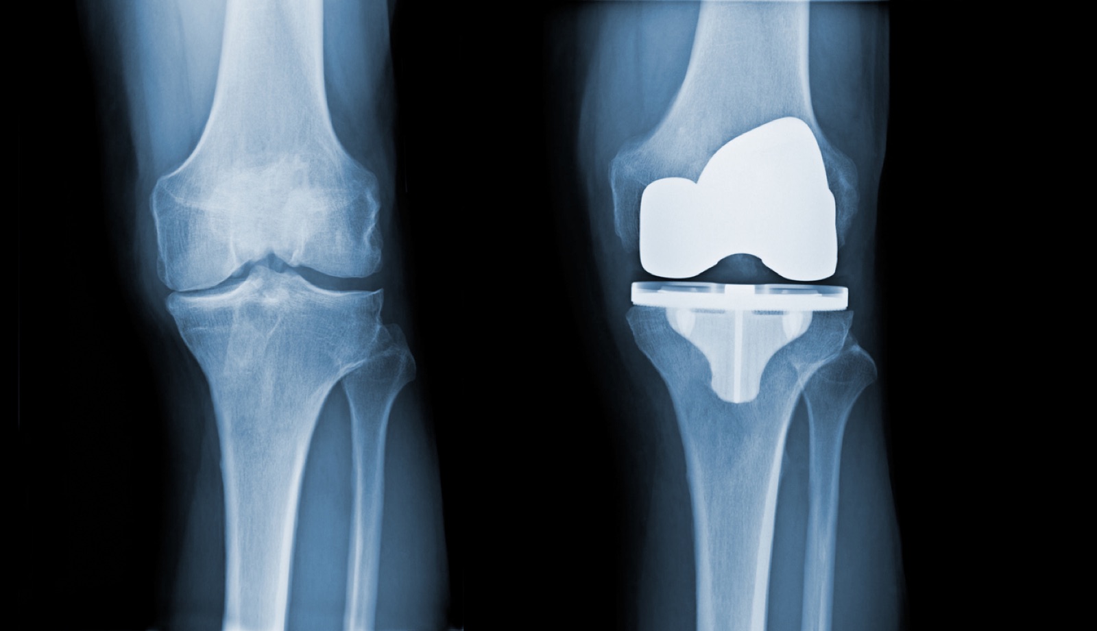 What Patients Should Know Before Knee Replacement