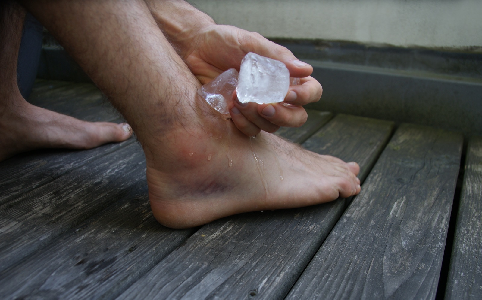 Ligament sprain