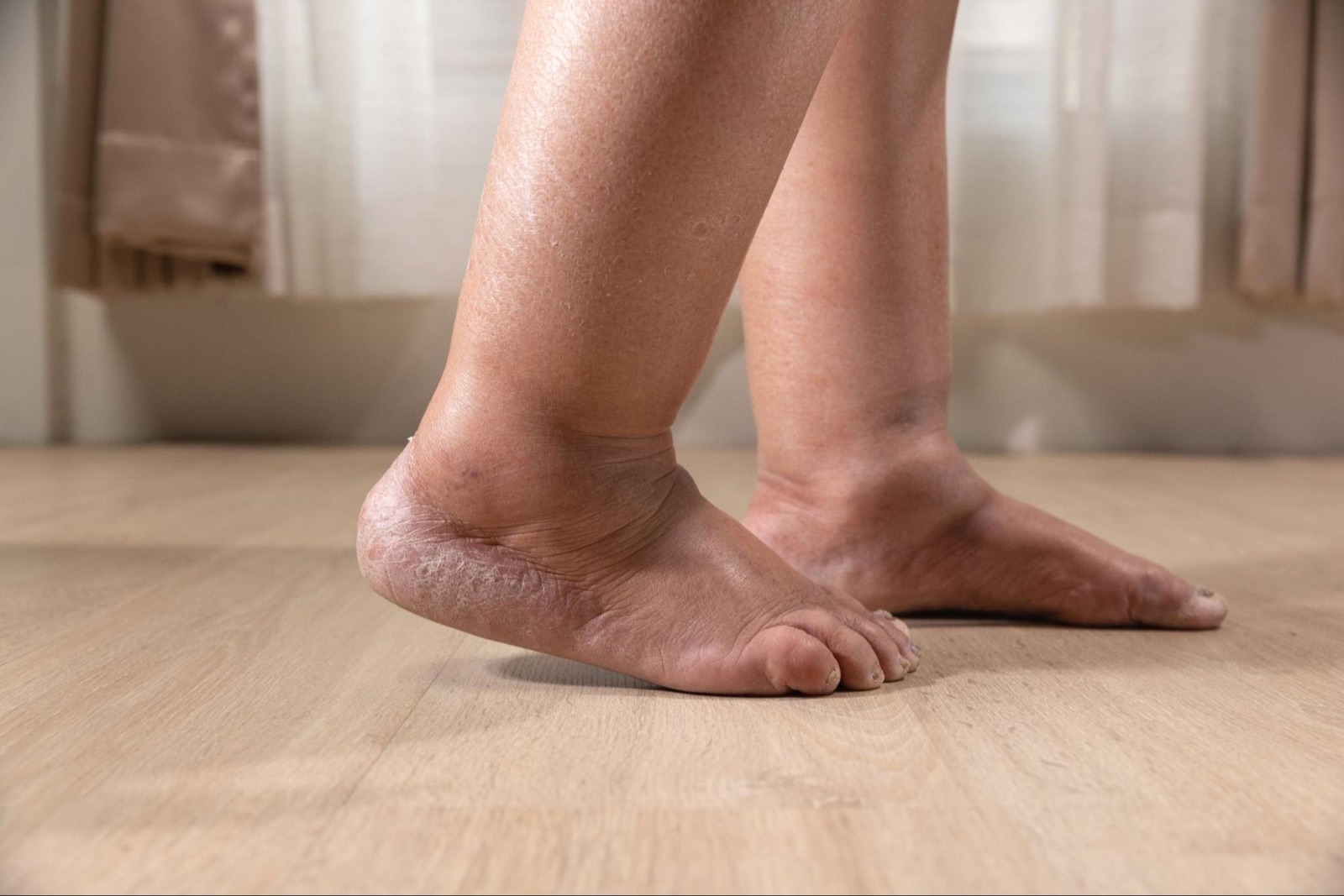 Neuropathy and Amputation Risk