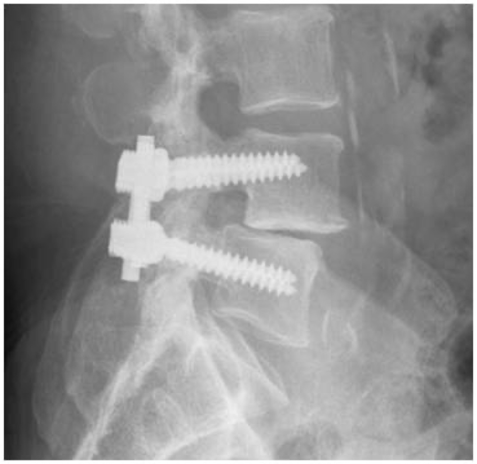 What Patients Should Know Before Spinal Surgery