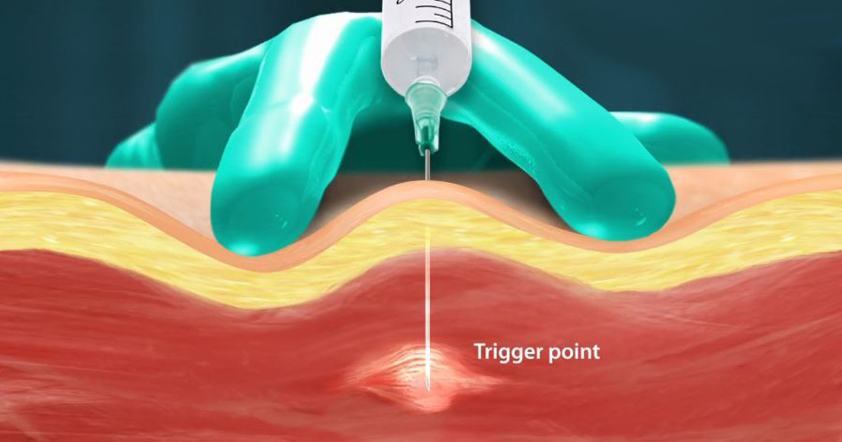 Trigger Point Injections
