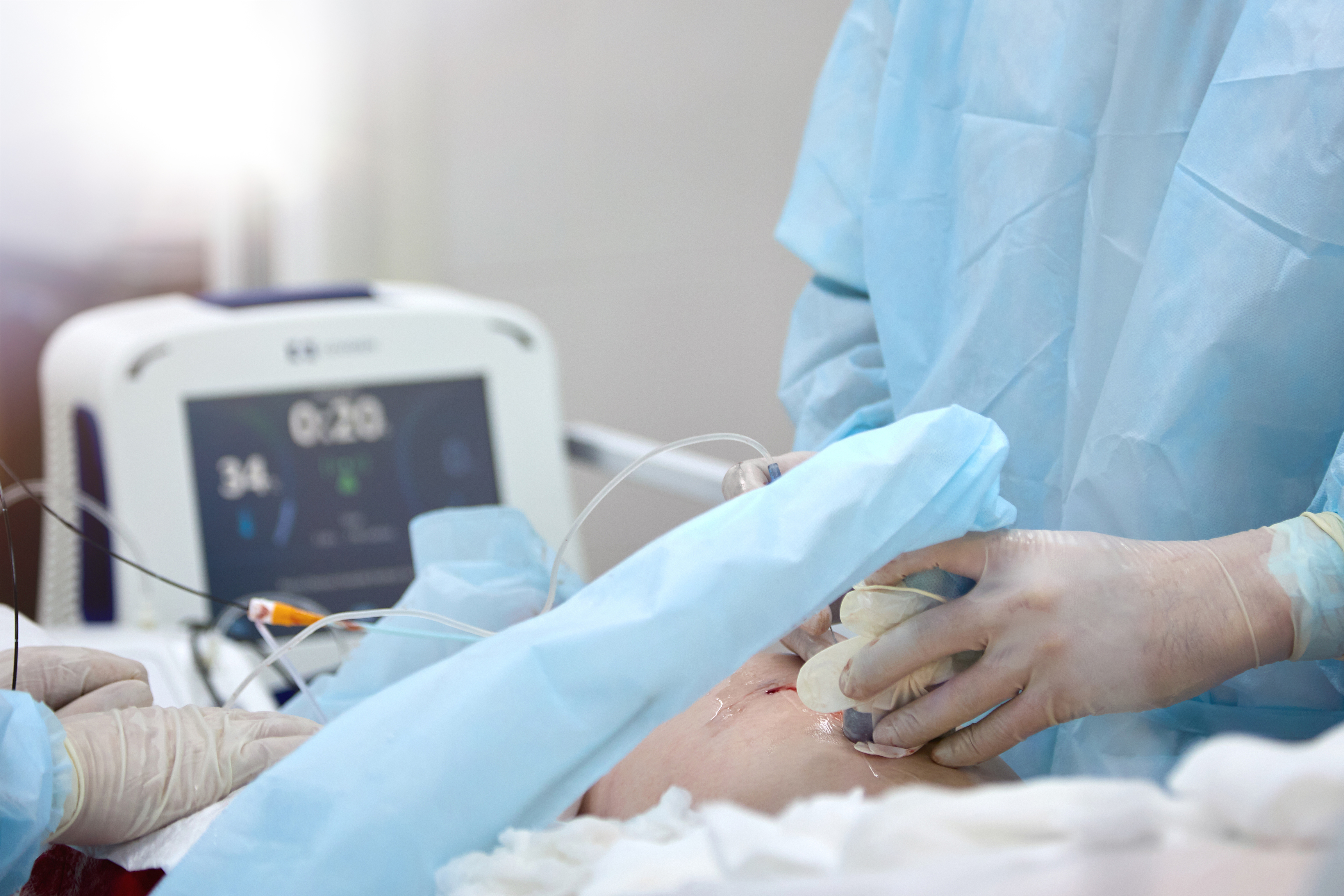 Endovenous radiofrequency ablation